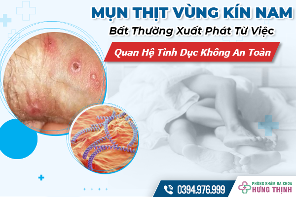 Mụn Thịt Vùng Kín Nam  - Bất Thường Xuất Phát Từ Việc Quan Hệ Tình Dục Không An Toàn