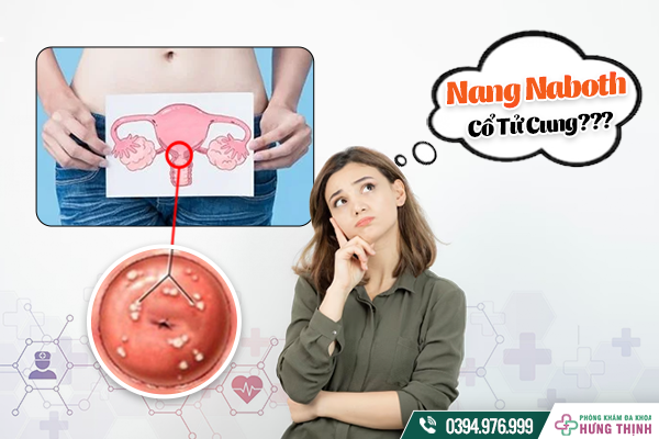 Nang Naboth Cổ Tử Cung: Bạn Biết Gì Về Căn Bệnh Này?