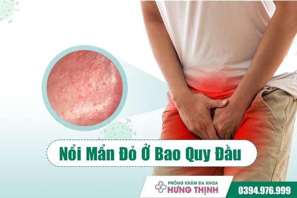 Nổi Mẩn Đỏ Ở Bao Quy Đầu: Tình Trạng Thường Thấy, Không Phải Cứ Chữa Là Khỏi!