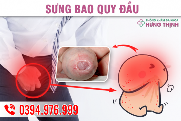 SƯNG BAO QUY ĐẦU LÀ BIỂU HIỆN CỦA BỆNH LÝ GÌ?