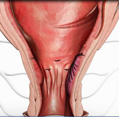 Cách điều trị bệnh trĩ nội hiệu quả