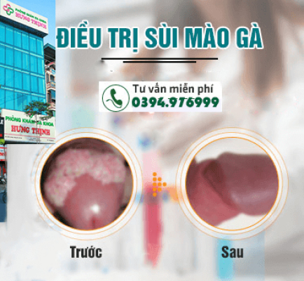 Đốt sùi mào gà như thế nào? Bao lâu thì khỏi