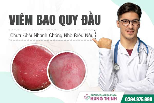 Viêm Bao Quy Đầu: Chữa Khỏi Nhanh Chóng Nhờ Điều Này!