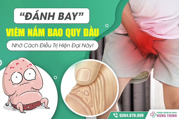 “Đánh Bay” Viêm Nấm Bao Quy Đầu Nhờ Cách Điều Trị Hiện Đại Này!