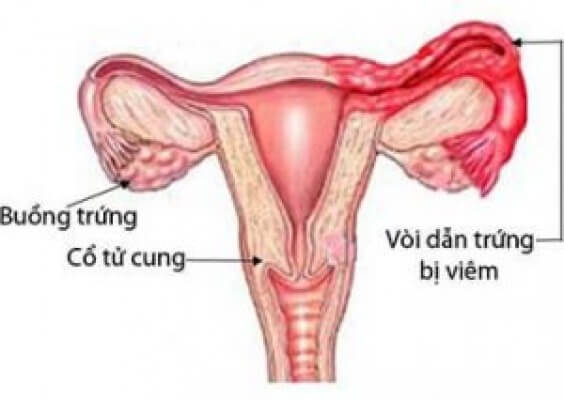 Phương pháp điều trị bệnh viêm vòi trứng hiệu quả