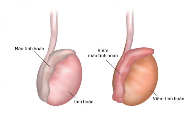 Viêm mào tinh hoàn: Có đáng lo ngại không? Những cách điều trị hiệu quả