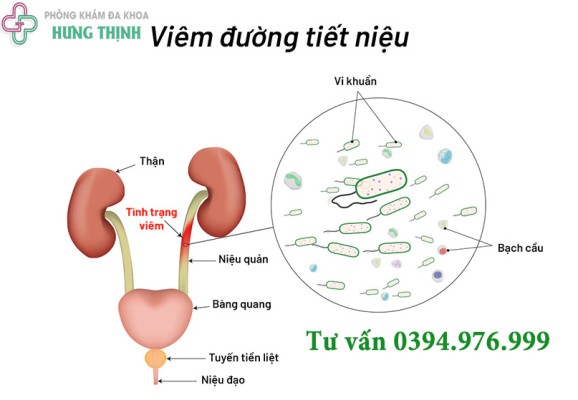 Viêm đường tiết niệu nam, nữ - nguyên nhân, triệu chứng, cách điều trị