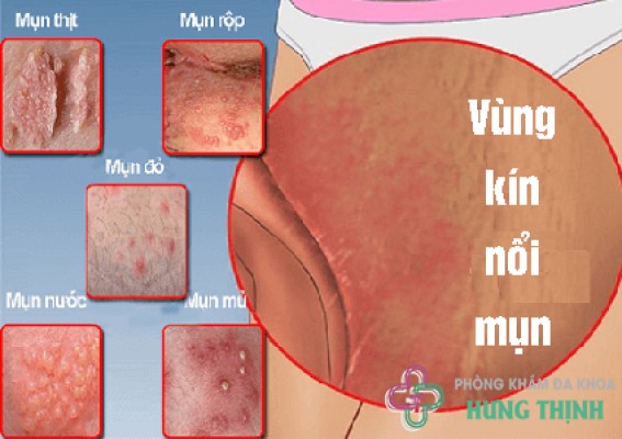 Nổi mụn dương vât : Nguyên nhân và cách điều trị 