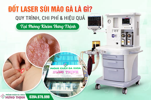 Đốt Laser Sùi Mào Gà Là Gì? Quy Trình, Chi Phí & Hiệu Quả Tại Phòng Khám Hưng Thịnh