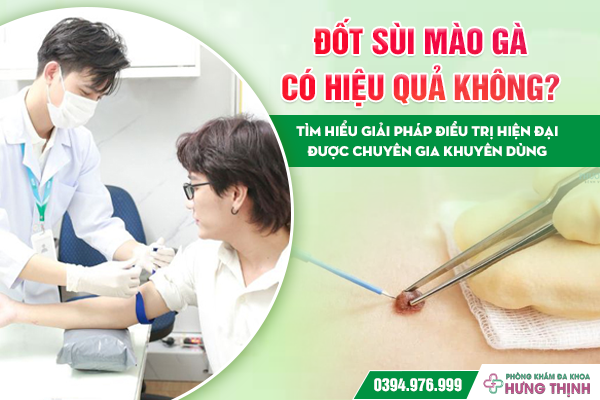 Đốt Sùi Mào Gà Có Hiệu Quả Không? Tìm Hiểu Giải Pháp Điều Trị Hiện Đại Được Chuyên Gia Khuyên Dùng