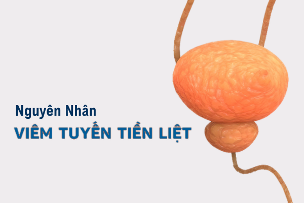 Nguyên nhân gây viêm tuyến tiền liệt ở nam giới là gì?