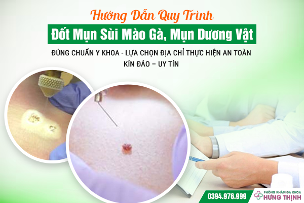Hướng Dẫn Quy Trình Đốt Mụn Sùi Mào Gà, Mụn Dương Vật Đúng Chuẩn Y Khoa - Lựa Chọn Địa Chỉ Thực Hiện An Toàn – Kín Đáo – Uy Tín